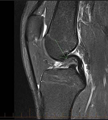 lateral meniscusb s.jpg